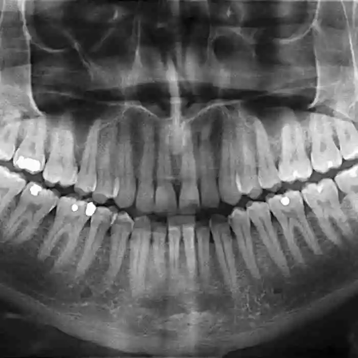 Teeth Segmentation